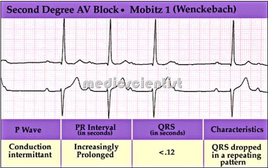 Second degree Atrioventricular Block