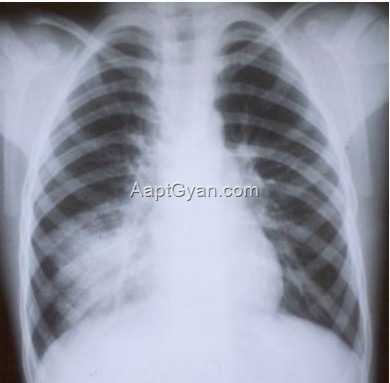 Pneumonia1
