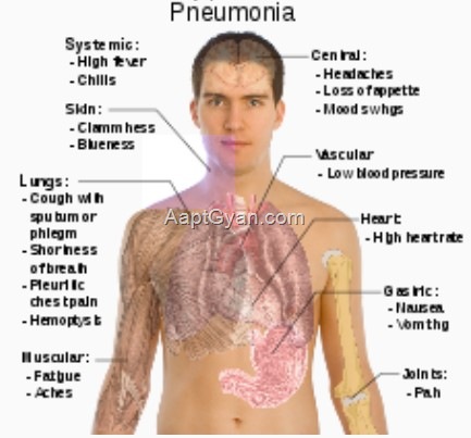 risk factors pneumonia