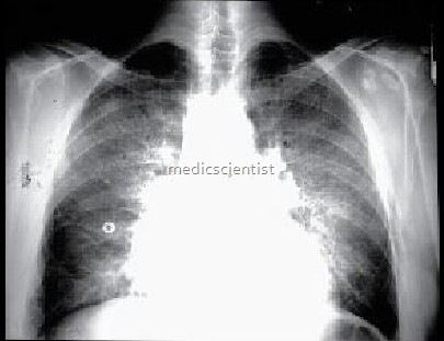 eosinophilic pneumonias