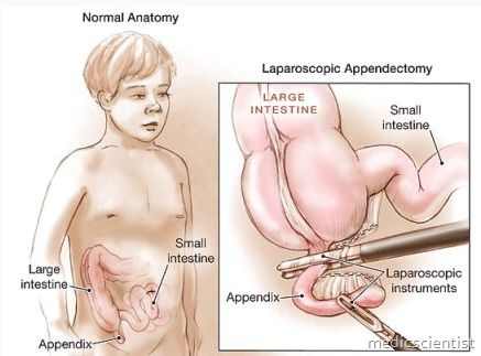 Appendicitis Pathophysiology