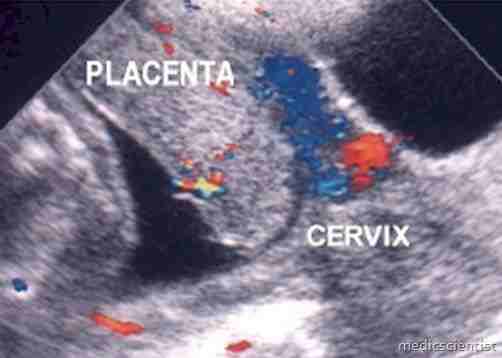 APH (Antepartum Haemorrhage)