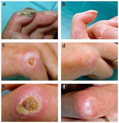 Systemic Sclerosis Classification Prognosis and Complications