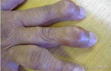 GOUT