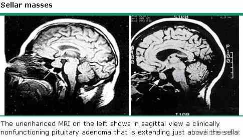 PITUITARY AND OTHER SELLAR MASSES