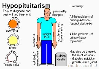 Hypopituitarismi