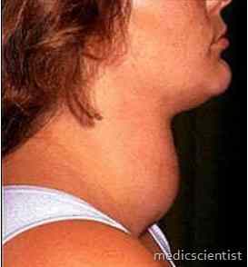 GOITER and THYROIDITIS