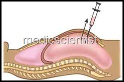 abdomen_ascites 15