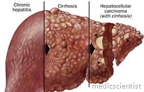 Alcoholic Liver Disease3