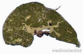 BILIARY CIRRHOSIS