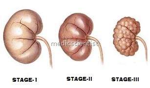 Chronic Renal Failure (CRF)2