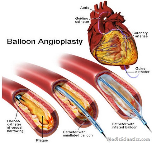 Heart blockage angioplasty Ayurvedic Medicine