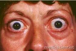 THYROTOXICOSIS 1