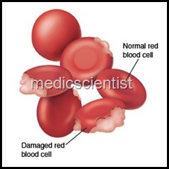 hemolytic anaemia
