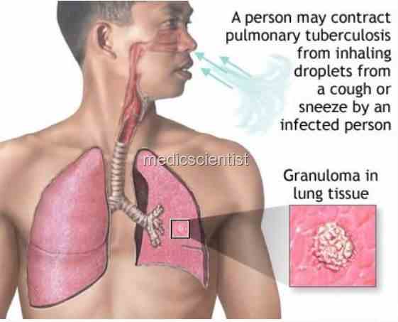 Tuberculosis2