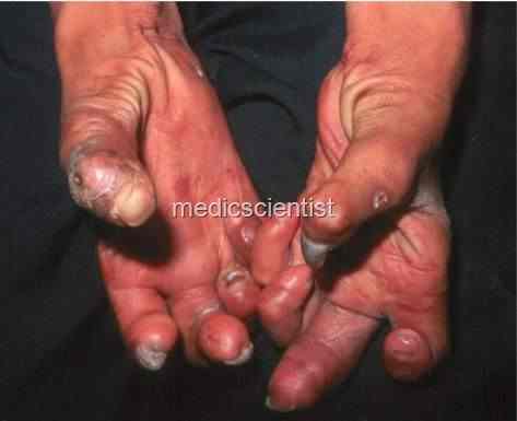 Complications of Leprosy Extremities