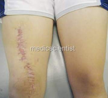 Musculo skeletal infections