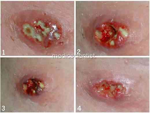 STAPHYLOCOCCAL INFECTIONS