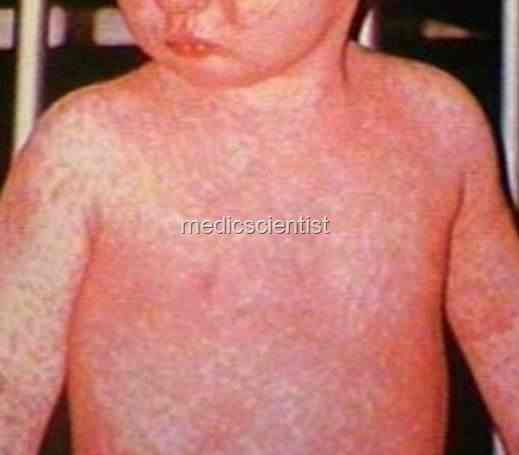 MEASLES oi