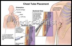 tubethorectomy