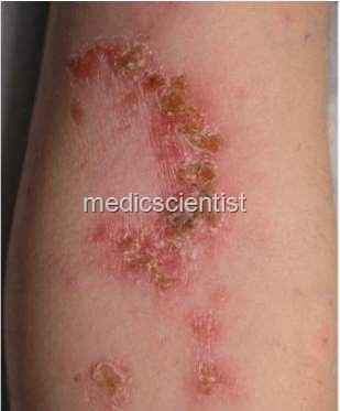 Streptococci Bacterial Infections 4