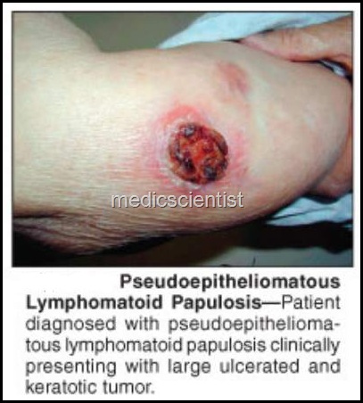 Lymphoid Malignancies gr