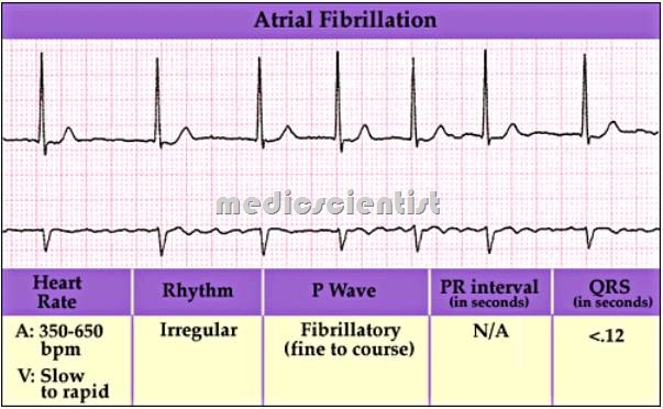 Atrial fibrillation 1