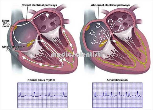 Cardiac Arrhythmias 2