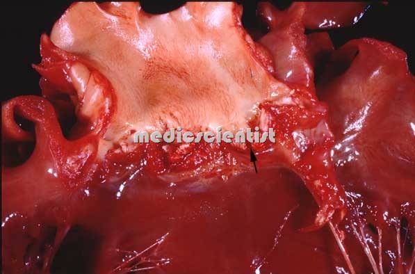 Infective Endocarditis  1