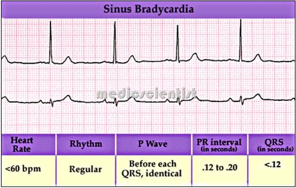 Sinus Bradycardia 1
