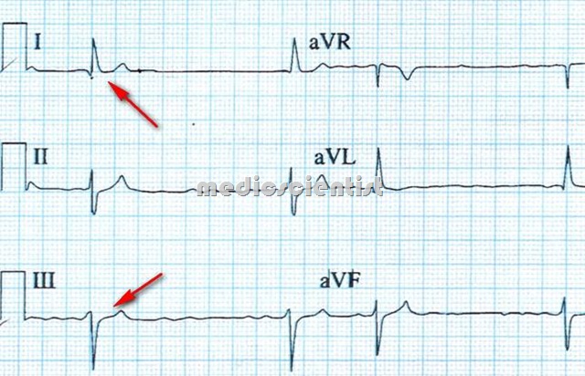 The cardiac axis Left Axis Deviation