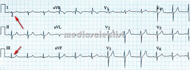 The cardiac axis Right Axis Deviation