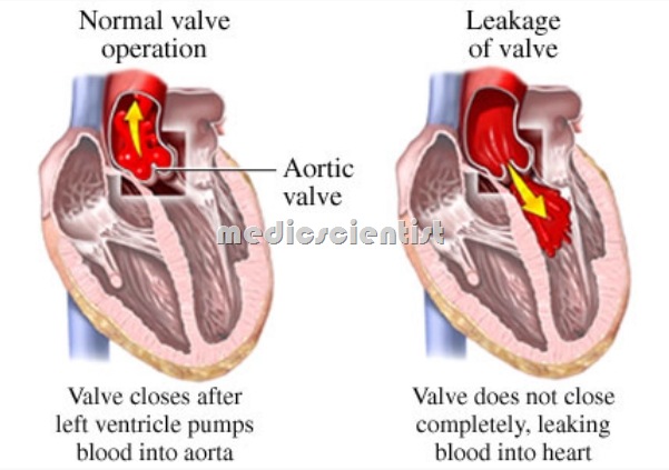 Aortic Regurgitation 1