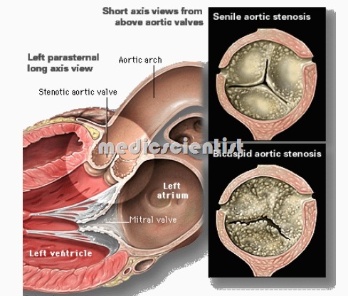 Malar Flush Mitral Stenosis Malar Flush Mitral Stenosis