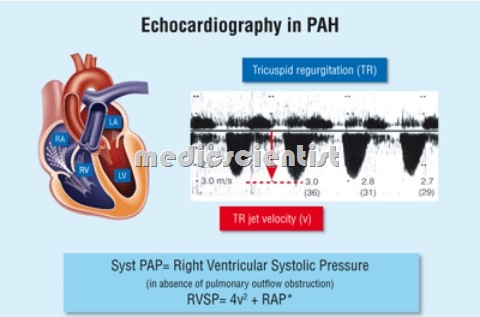 Pulmonary Hypertension ecocardiography