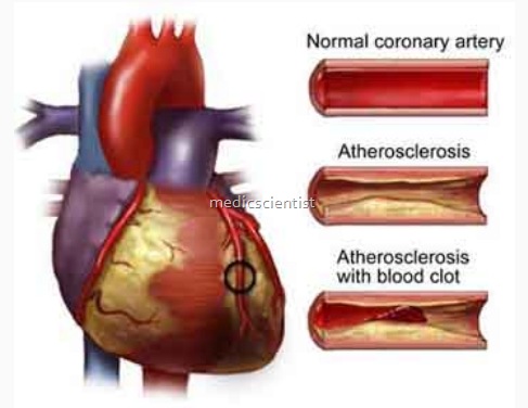 Atherosclerosis 1