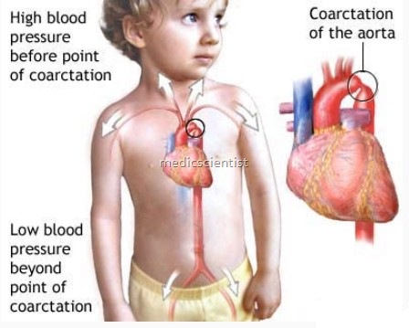 Clinical features Coarctation of the Aorta 1