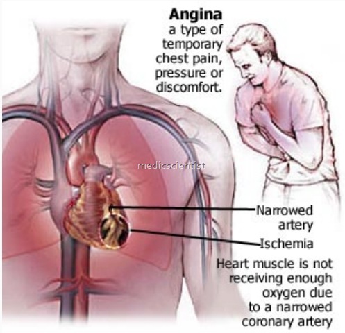Unstable Angina 1