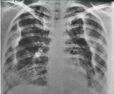 CHRONIC eosinophilic pneumonias