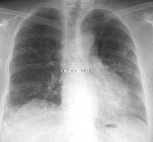 Interstitial Lung Diseases 1