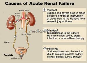 Acute Renal Failure (ARF) 1