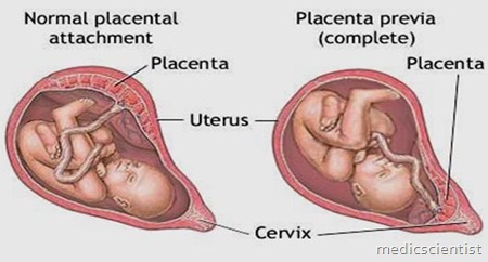 Placenta previa (PP)