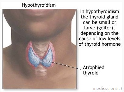 HYPOTHYROIDISM1