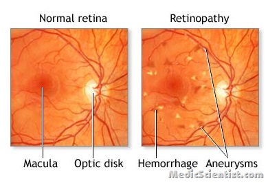 Ophthalmologic Complications of DM 2